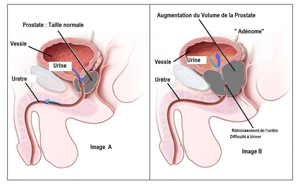 Traitement naturel prostate